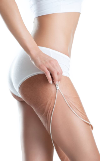 Лечение целлюлита